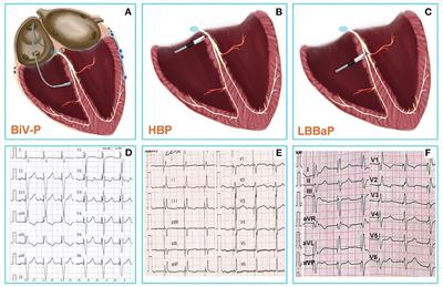 Success rates, challenges and troubleshooting of left bundle branch area pacing as a cardiac resynchronization therapy for treating patients with heart failure